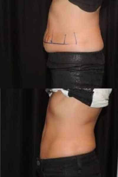 HIEMT Muscle Toning Warwickshire