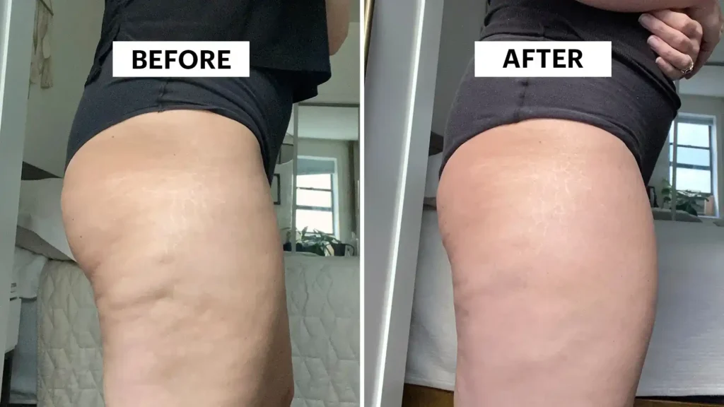 Sculpting Your Bum: Can Toning Exercises Really Reduce Cellulite? 1 Do Toning Exercise Warwickshire Really Tackle Cellulite?