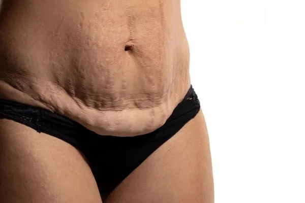 The Science of Skin Tightening 1 The science behind skin tightening Warwickshire picture of a woman's sagging skin on the stomach